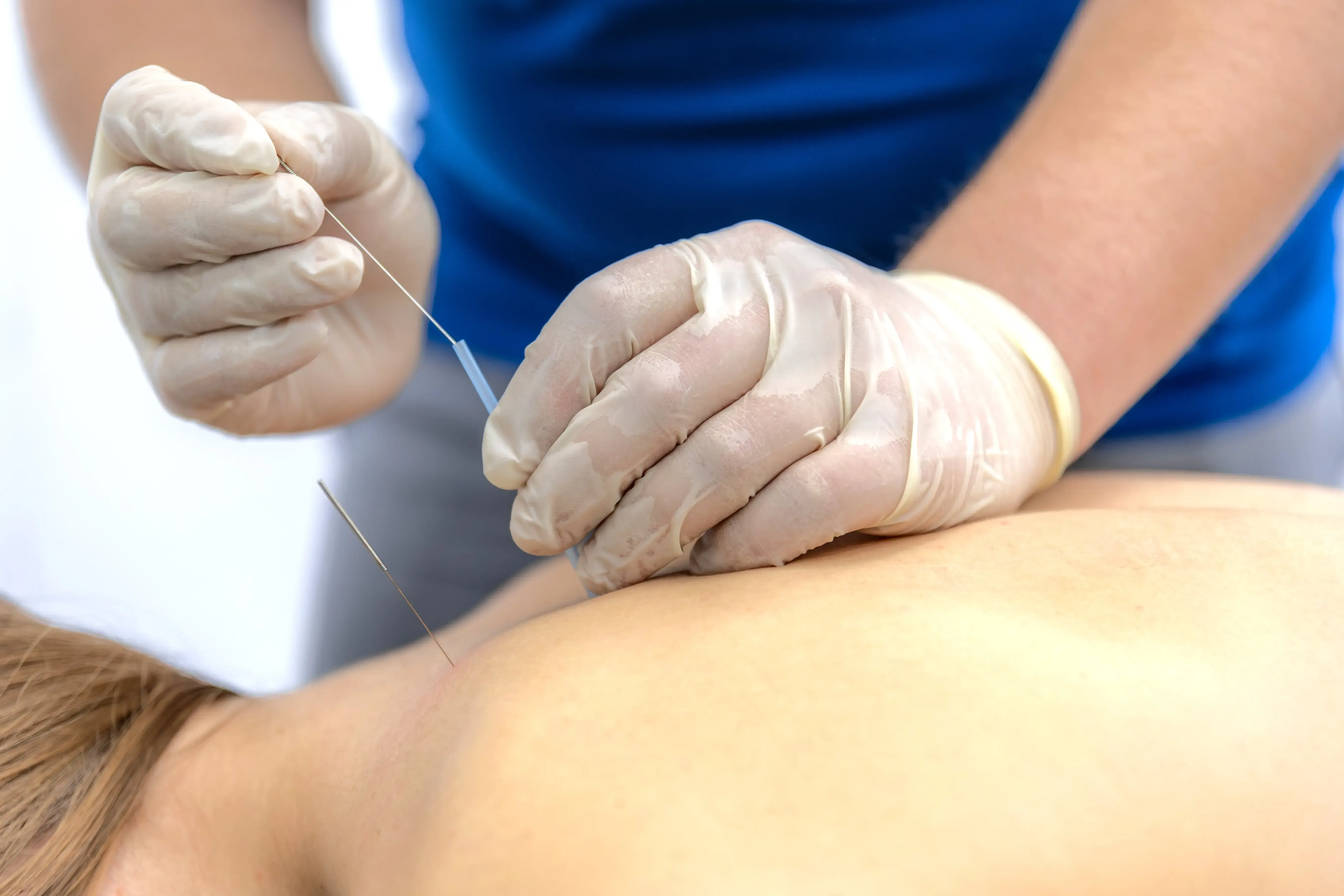 Dry needling vs acupuncture at Spine-Ability in Apollo Beach and Riverview, FL