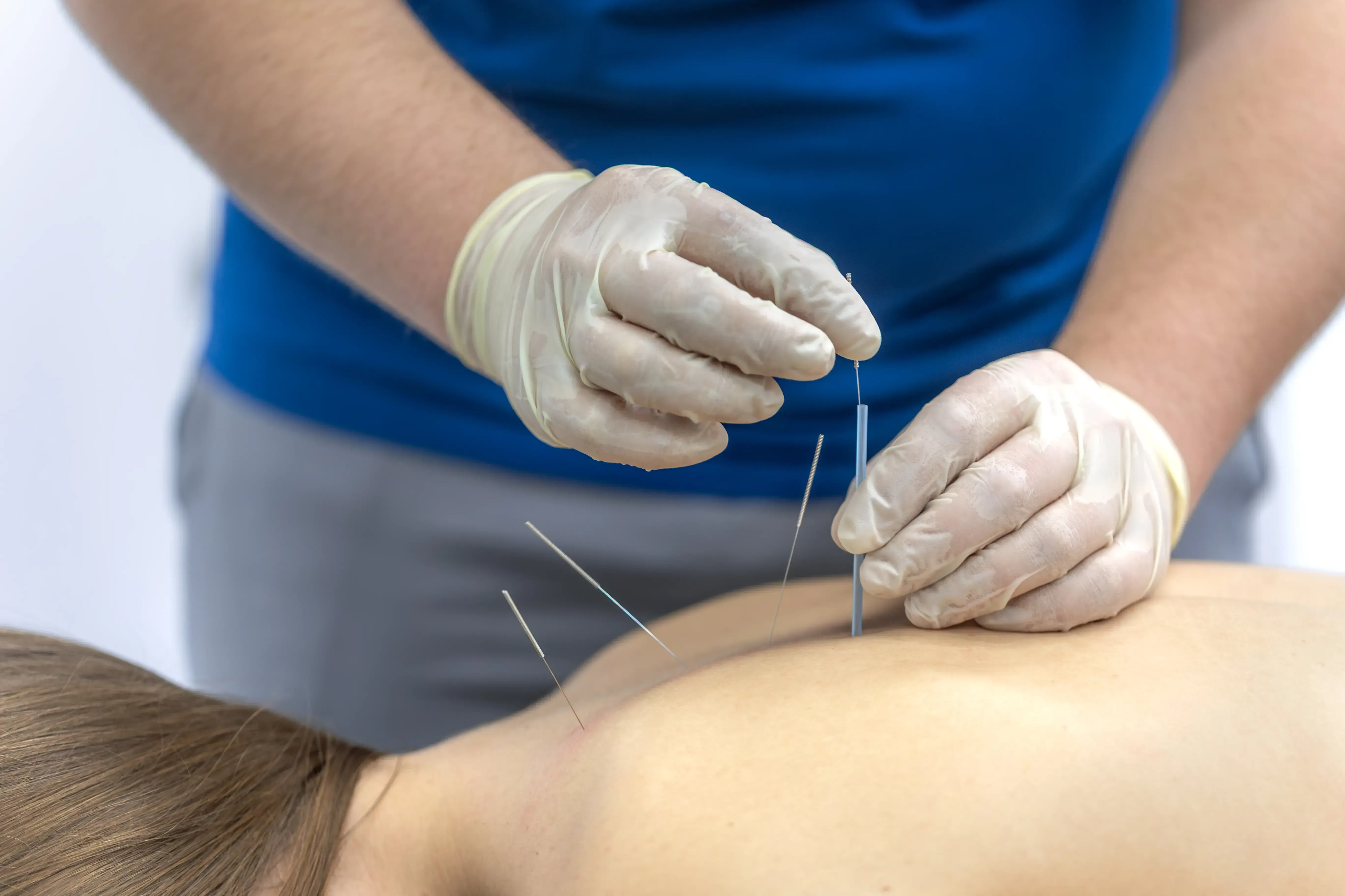 Acupuncture treatment at Spine-Ability Chiropractic and Wellness in Apollo Beach FL